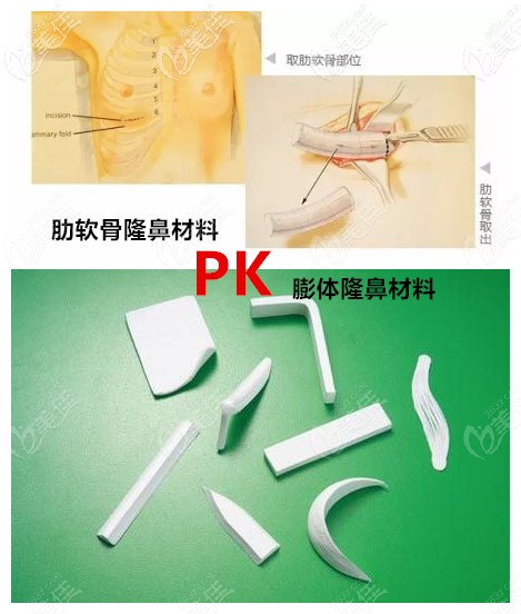 肋軟骨隆鼻和膨體隆鼻的對比