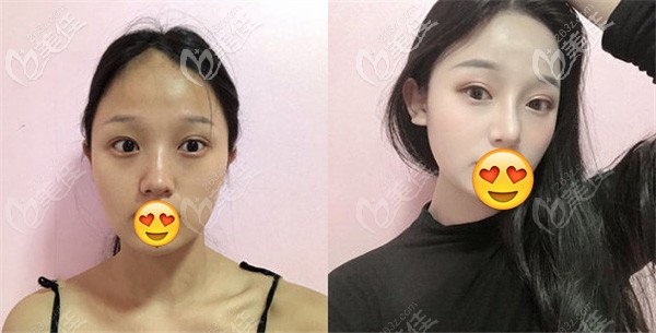 找雷醫(yī)生做鼻綜合的手術(shù)效果