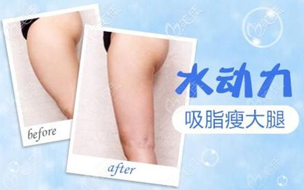 德國水動(dòng)力吸脂效果怎么樣