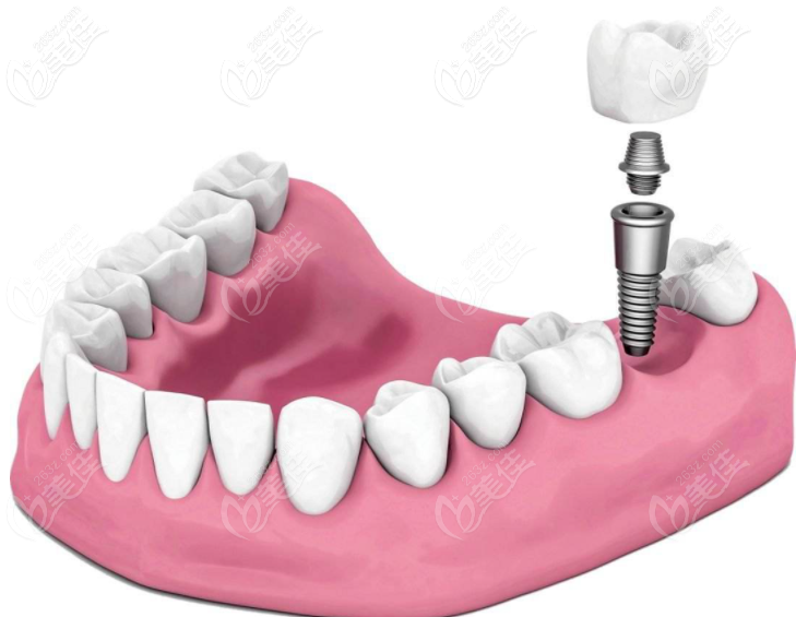 種植牙為什么這么貴