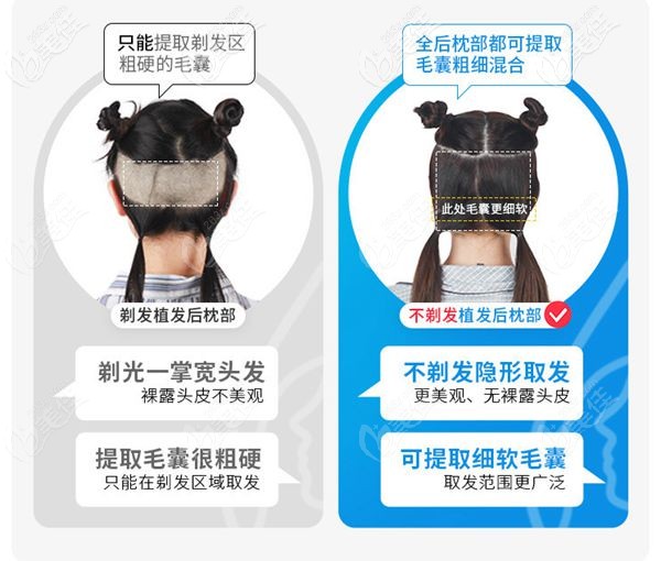 成都首瑞不剃發(fā)植發(fā)技術(shù)