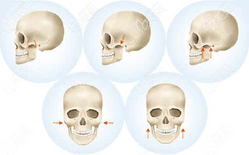 何院長做顴骨整形的手術(shù)原理 何院長做顴骨整形的手術(shù)原理