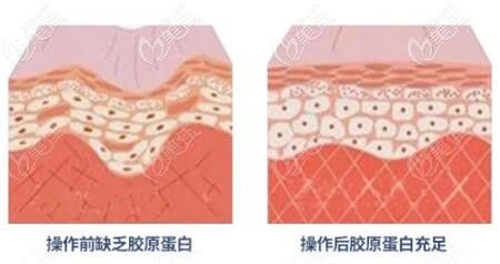 熱瑪吉抗衰皮膚前后效果對比變化示意圖 熱瑪吉抗衰皮膚前后效果對比變化示意圖