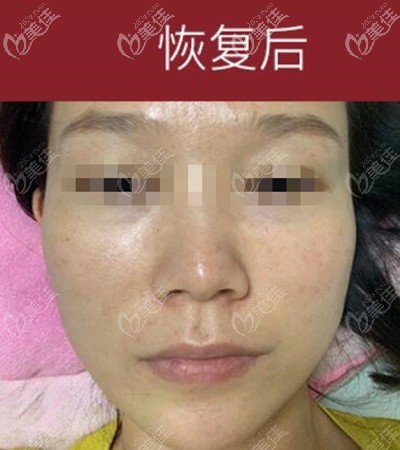 遺傳雀斑在洛陽毛大夫做皮秒爆破祛斑第30天的恢復效果圖來嘍