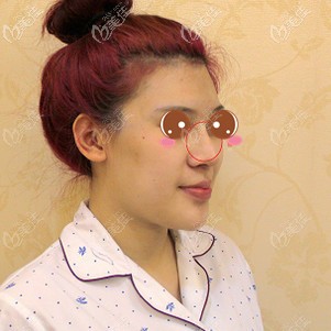 鼻修復(fù)前鼻子假體明顯 鼻修復(fù)前鼻子假體明顯