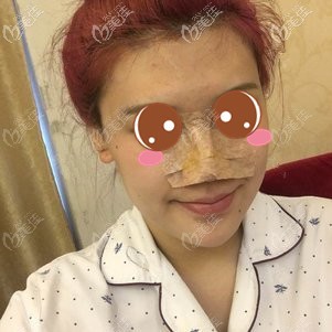 在福州格萊美做鼻修復(fù)術(shù)后2天 在福州格萊美做鼻修復(fù)術(shù)后2天