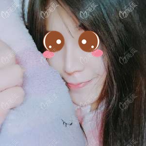 在福州格萊美做鼻修復(fù)術(shù)后7天 在福州格萊美做鼻修復(fù)術(shù)后7天