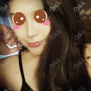 在福州格萊美做鼻修復(fù)術(shù)后1個月 在福州格萊美做鼻修復(fù)術(shù)后1個月