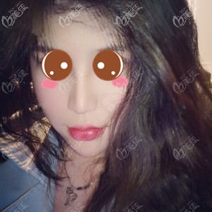 在福州格萊美做鼻修復(fù)術(shù)后2個月 在福州格萊美做鼻修復(fù)術(shù)后2個月