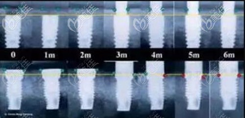 德國AnkyLos種植體長短要求