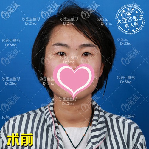 大連沙醫(yī)生雙眼皮案例 大連沙醫(yī)生雙眼皮案例