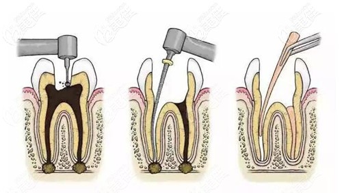 根管治療的過(guò)程 根管治療的過(guò)程