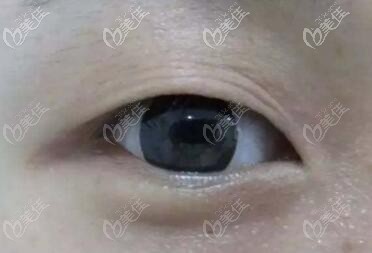 上眼皮松弛可以做納米無痕雙眼皮嗎