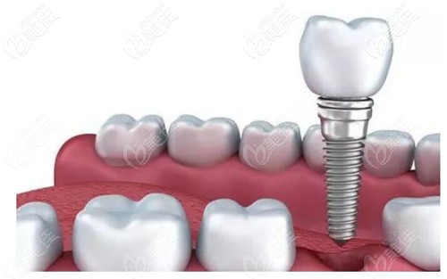 德國(guó)卡瓦abt口腔種植體
