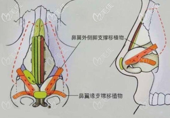 鼻翼緣后縮修復(fù)術(shù)圖解 鼻翼緣后縮修復(fù)術(shù)圖解