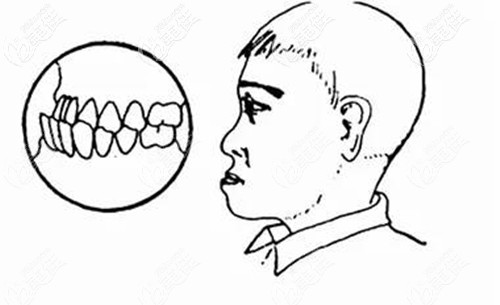 地包天的矯正方式