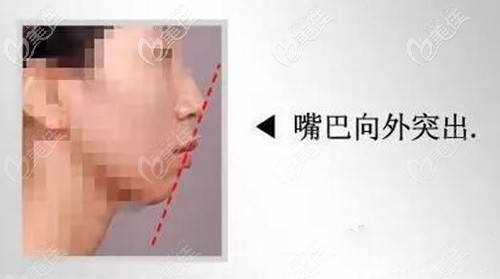 單純嘴凸矯正方式