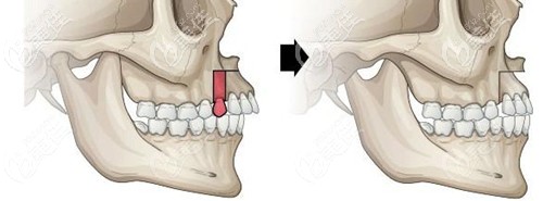 短下巴嘴凸矯正方式