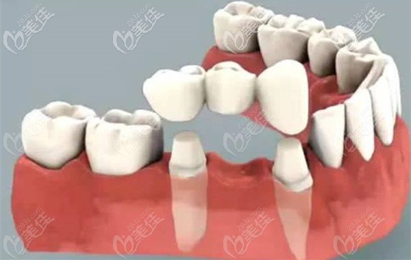 瓷貼面手術(shù)的原理