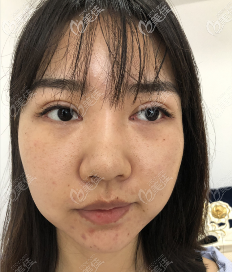 深圳南雅醫(yī)療美容整形門診部張穎杰術(shù)前照片1