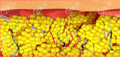 快樂(lè)吸脂手術(shù)過(guò)程示意圖 快樂(lè)吸脂手術(shù)過(guò)程示意圖