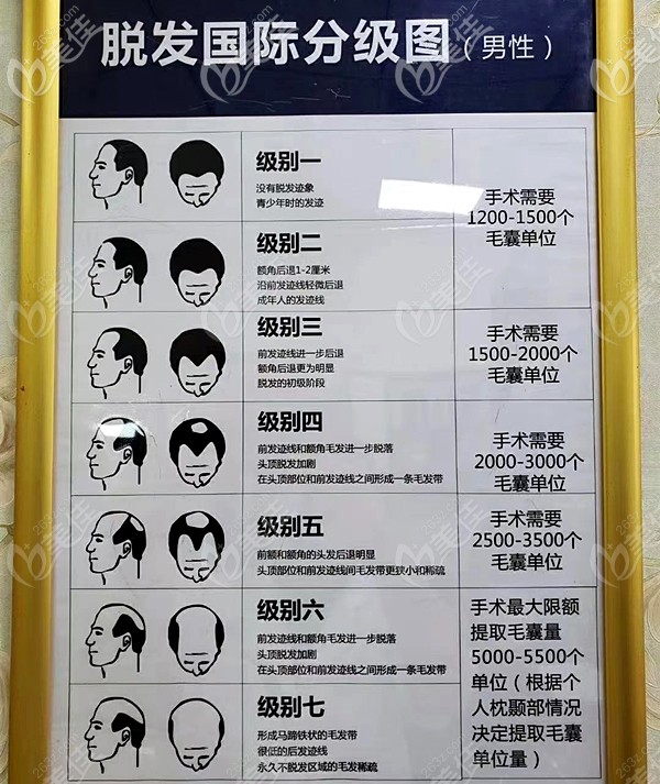 男性4級(jí)脫發(fā)m型發(fā)際線后退4厘米植發(fā)需要種植多少株毛囊