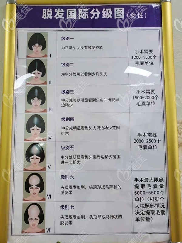 女生4級(jí)脫發(fā)植發(fā)需要多少毛囊