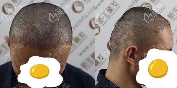 4級(jí)M型脫發(fā)需要種植多少個(gè)毛囊單位？