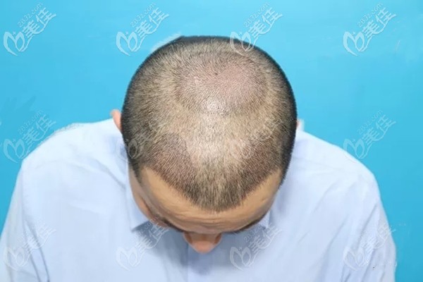 廣州碧蓮盛4級(jí)M型脫發(fā)需要種植多少個(gè)毛囊單位？