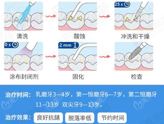 窩溝封閉過程 窩溝封閉過程