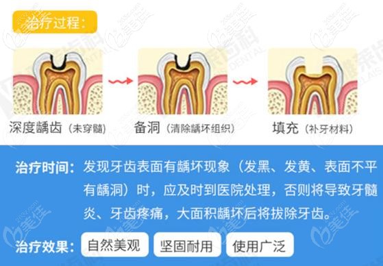 樹脂補牙過程 樹脂補牙過程
