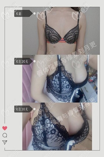 深圳軍科劉月更隆胸案例