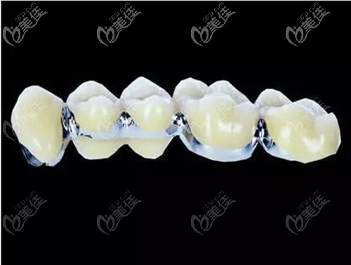 鈷鉻內(nèi)冠烤瓷牙