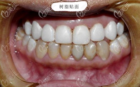 樹脂貼面修復(fù)效果圖