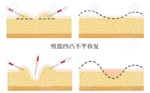 大腿吸脂失敗修復(fù)辦法