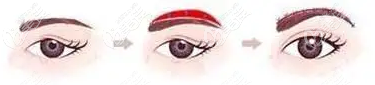 提眉手術(shù)過程示意圖