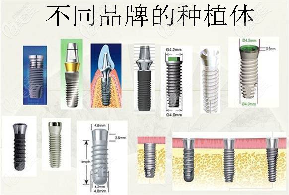 不同品牌種植體包括韓國植體系列 不同品牌種植體包括韓國植體系列