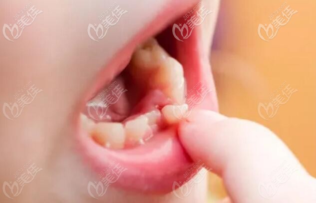 乳牙和恒牙更換期