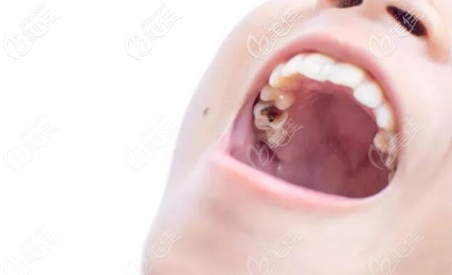 齲齒的發(fā)育