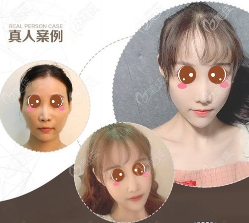 北京藝美王東不開刀降顴骨對比圖