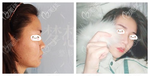 <!--<i data=20240703-sp></i>-->的肋骨鼻子案例