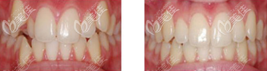 隱形矯正前后對比效果圖