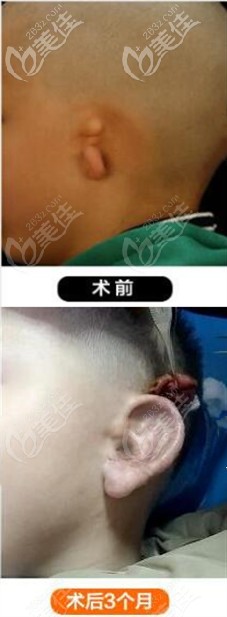 安波耳再造手術(shù)