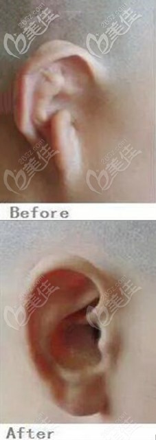 王馳耳再造前后對(duì)比圖