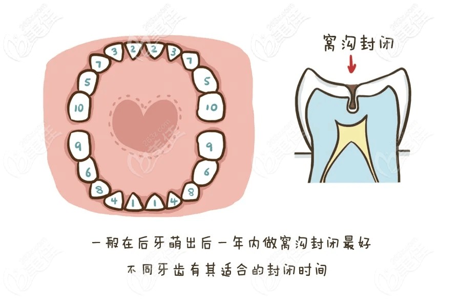 窩溝封閉幾歲做合適