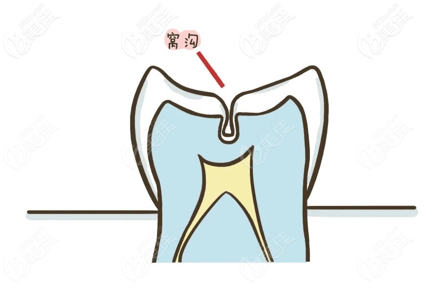 窩溝封閉有必要做嗎