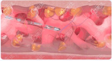 張悅迪醫(yī)生做面部抽脂不損傷血管網(wǎng) 張悅迪醫(yī)生做面部抽脂不損傷血管網(wǎng)