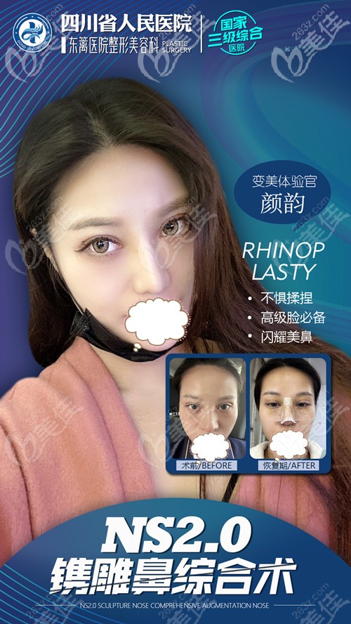 成都東籬自體肋軟骨鼻綜合案例效果圖 成都東籬自體肋軟骨鼻綜合案例效果圖