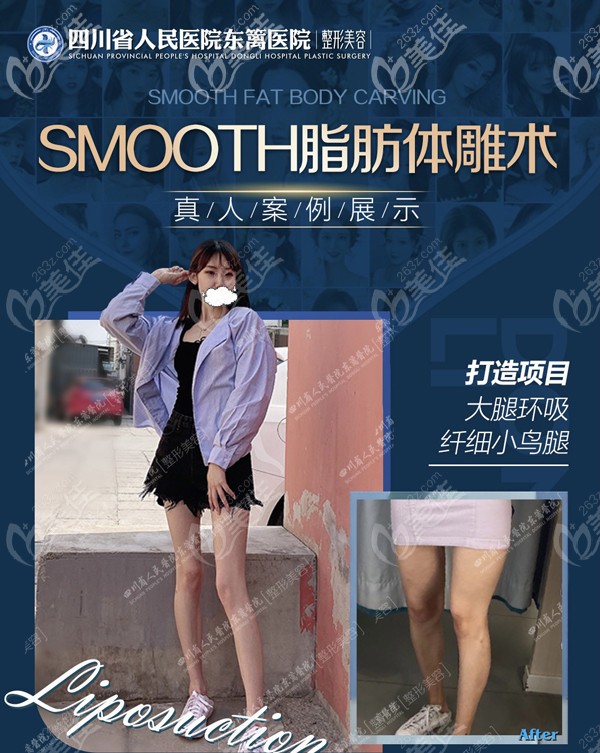 四川東籬整形醫(yī)院大腿吸脂真實(shí)對(duì)比照片 四川東籬整形醫(yī)院大腿吸脂真實(shí)對(duì)比照片