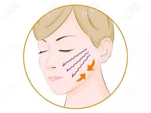 緊繃感不是因為臉腫